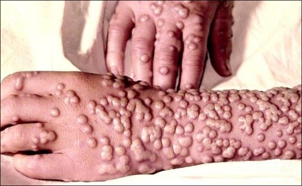 sintomas mais comuns da varíola