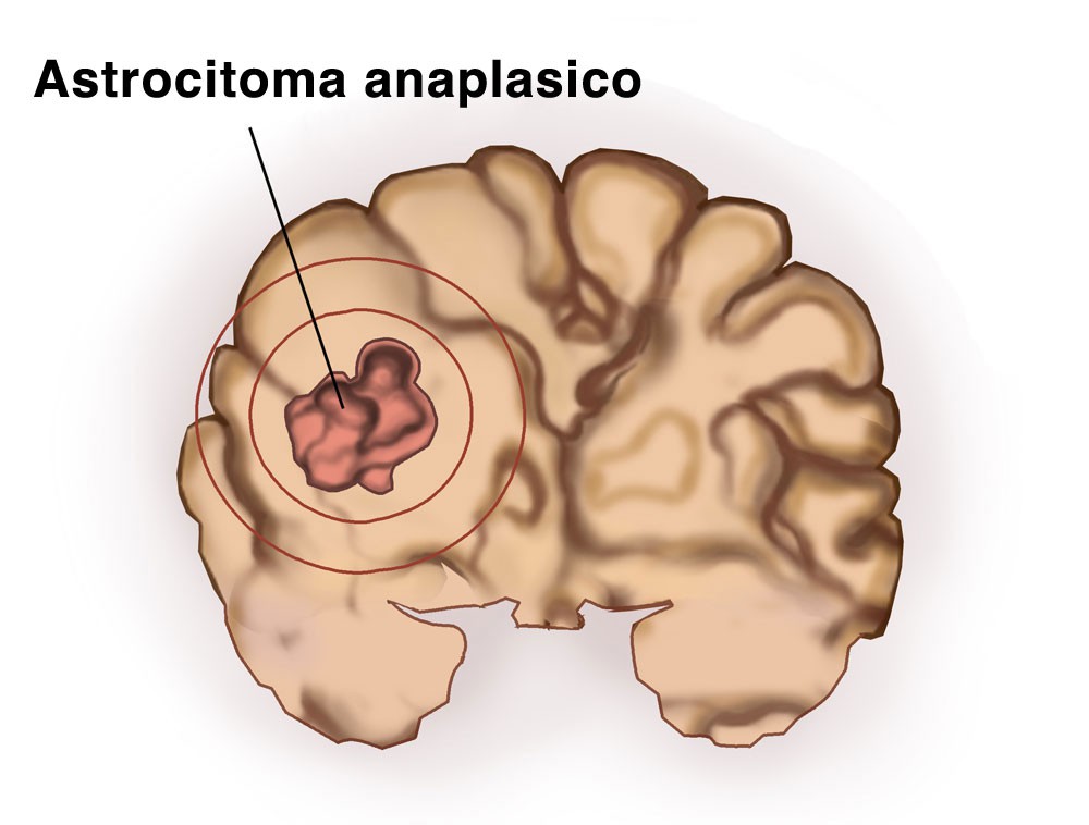 Astrocitoma: O que é, causas e tratamentos
