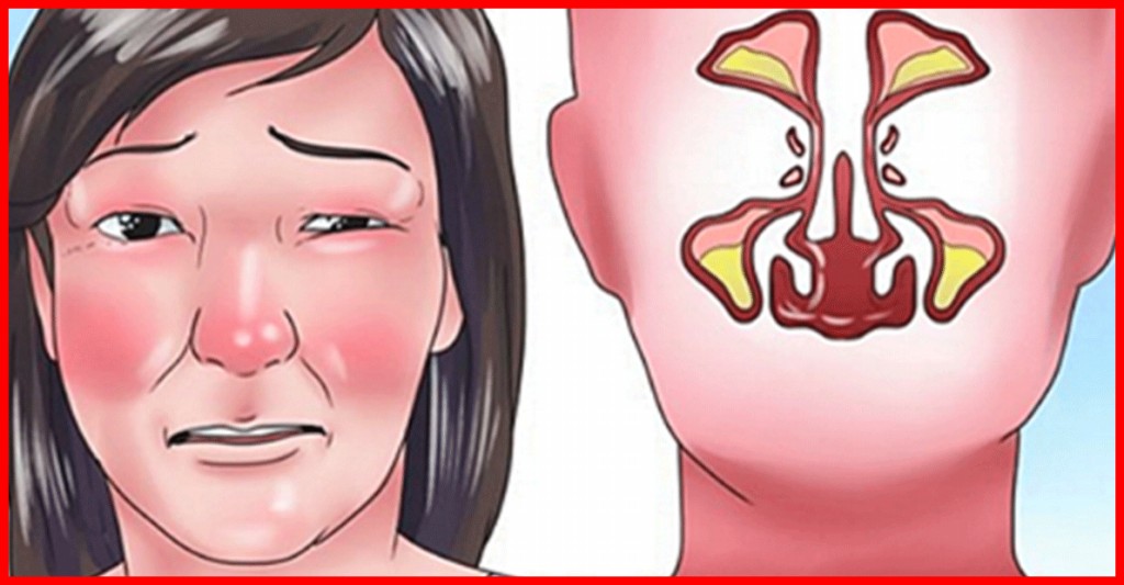 congestao nasal