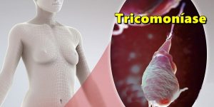 prevenir a tricomoníase