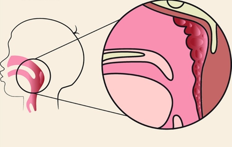 Adenoidite: o que é, causas, sintomas e tratamentos