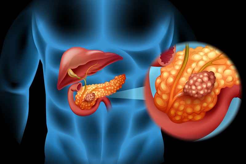 Câncer de Pâncreas: o que é, causas, sintomas e tratamento