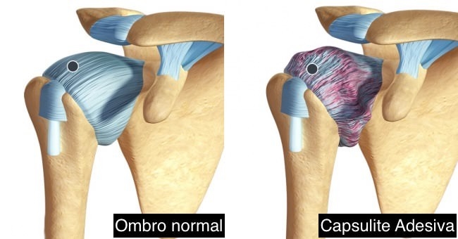 Capsulite Adesiva: o que é, causas, sintomas e tratamentos