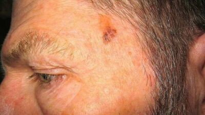 Carcinomas de Células Escamosas: causas, sintomas e tratamentos