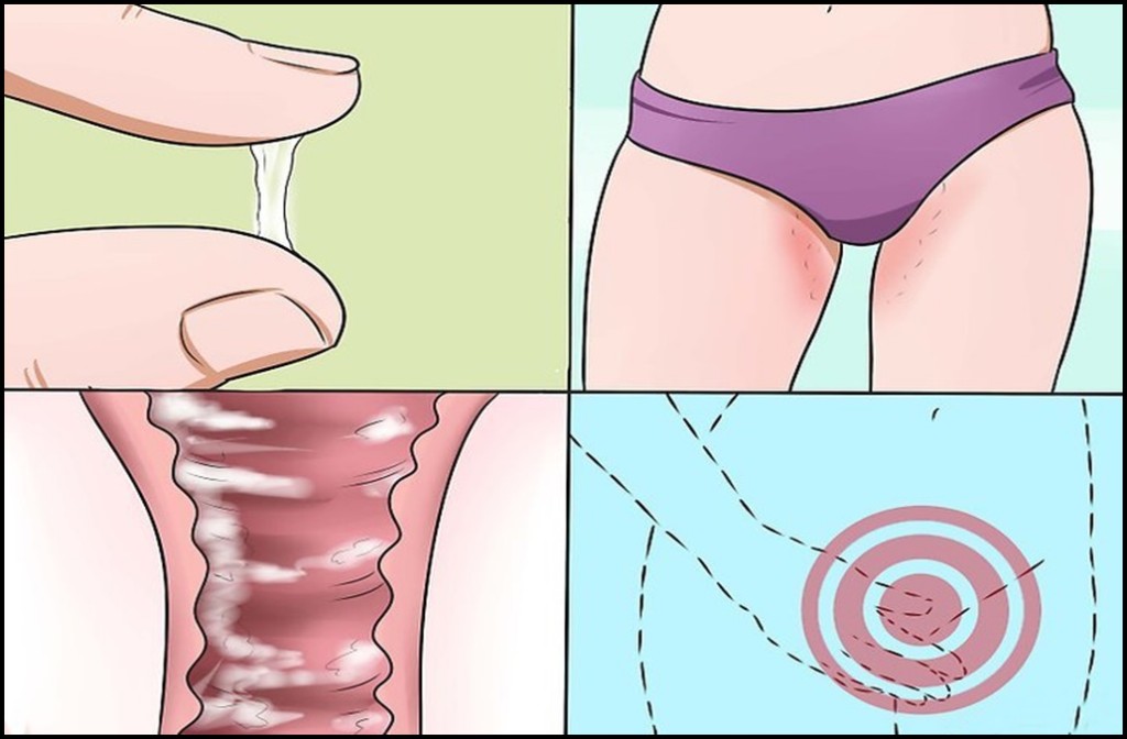 causas da candidiase vaginal