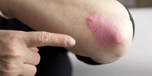 causas da eczema