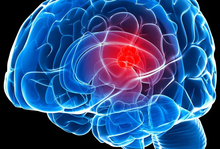 Meningioma: o que é, sintomas e tratamentos