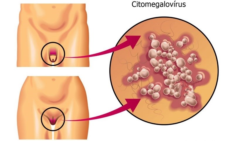 Citomegalovírus: o que é, causas, sintomas e tratamentos