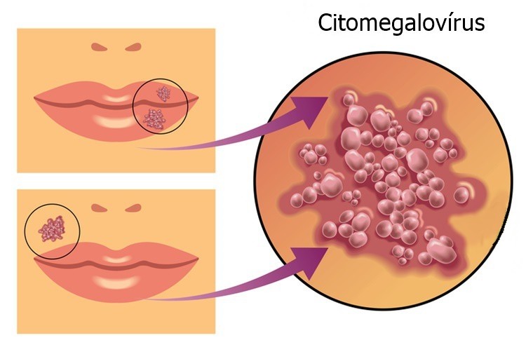 Citomegalovírus: o que é, causas, sintomas e tratamentos