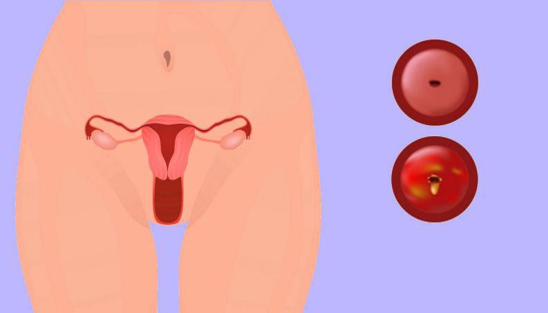 Corrimento vaginal: o que é, causas, sintomas e tratamentos