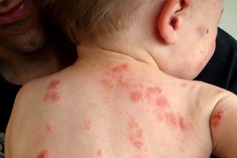 Eczema: o que é, causas, sintomas, diagnostico, tratamentos e como prevenir