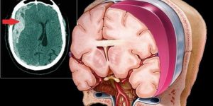 hematoma subdural