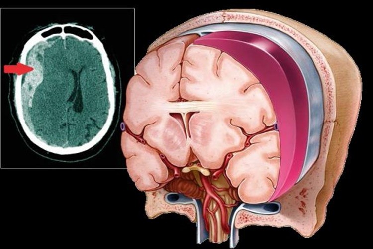 hematoma subdural