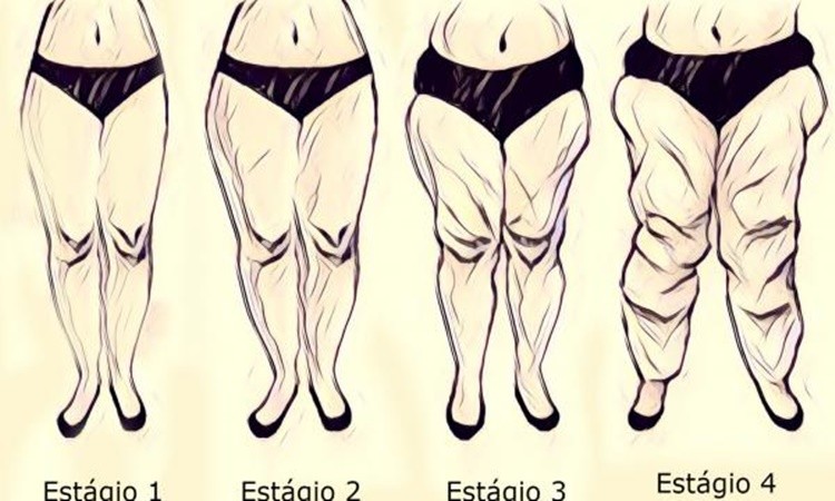 lipedema