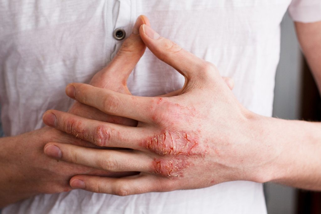 Eczema: o que é, causas, sintomas, diagnostico, tratamentos e como prevenir