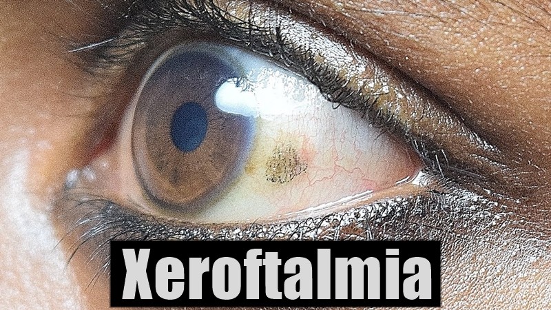 xeroftalmiaxeroftalmia