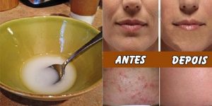 óleo de coco para eliminar rugas, pele flácida e acne