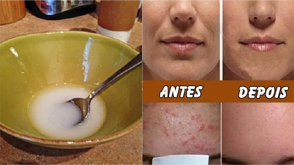 óleo de coco para eliminar rugas, pele flácida e acne