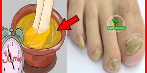 receita para eliminar os fungos dos pés e unhas