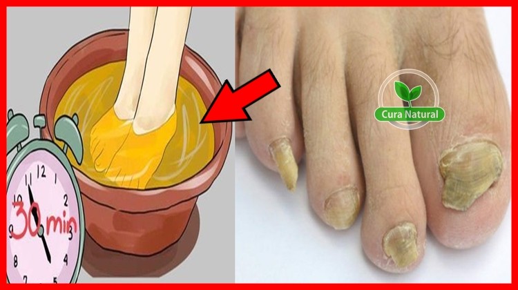 receita para eliminar os fungos dos pés e unhas