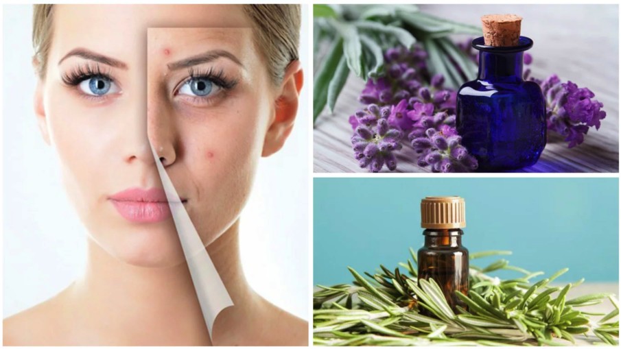 óleos essenciais para combater a acne