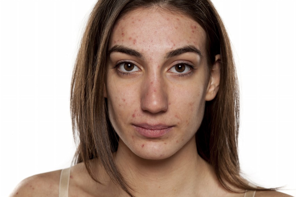 óleos essenciais para combater a acne