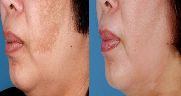 Ácidos: para tirar manchas escuras do rosto: tipos e benefícios